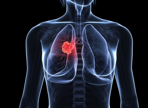 Ung thư phổi có lây không? Tìm hiểu ngay trước khi quá muộn